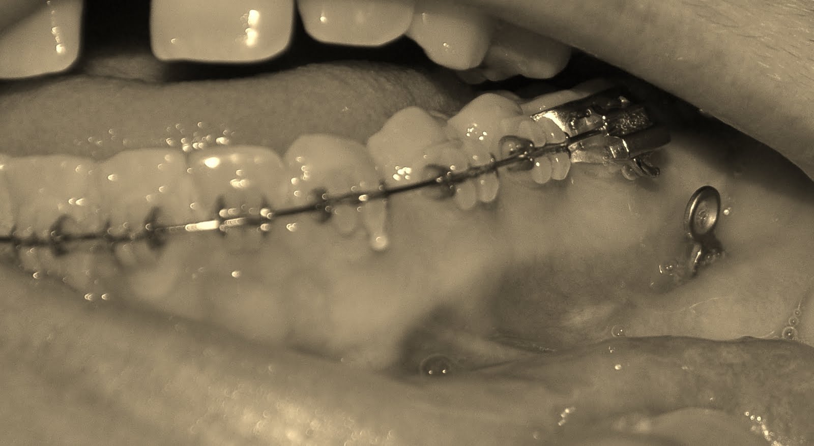 Belinda's SARPE/SARME Jaw surgery Photo of my titanium anchorage plates