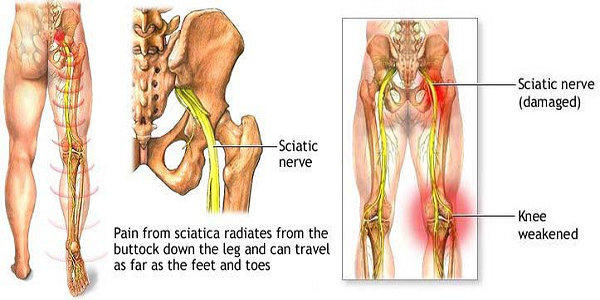 Get Rid Of Your Lower Back Pain-Sciatica By Doing These Simple Exercises sciatica