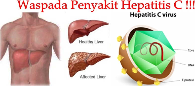 Pengobatan Alternatif Hepatitis C Tradisional