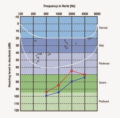 unaided afif sound audiogram hearing