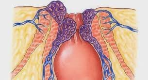 wasir obat wasir setadium 2