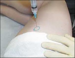 Trochanteric bursa steroid injection