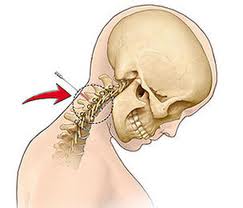 Epidural steroid injection frequency