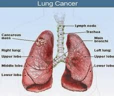 alternatif kanker Paru stadium 3, obat kanker paru, pengobatan kanker paru
