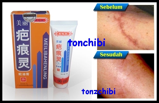 tonzbodycares toko kosmetik meilibahenling penghilang segala jenis bekas luka di kulit tonzbodycares toko kosmetik meilibahenling penghilang segala jenis bekas luka di kulit