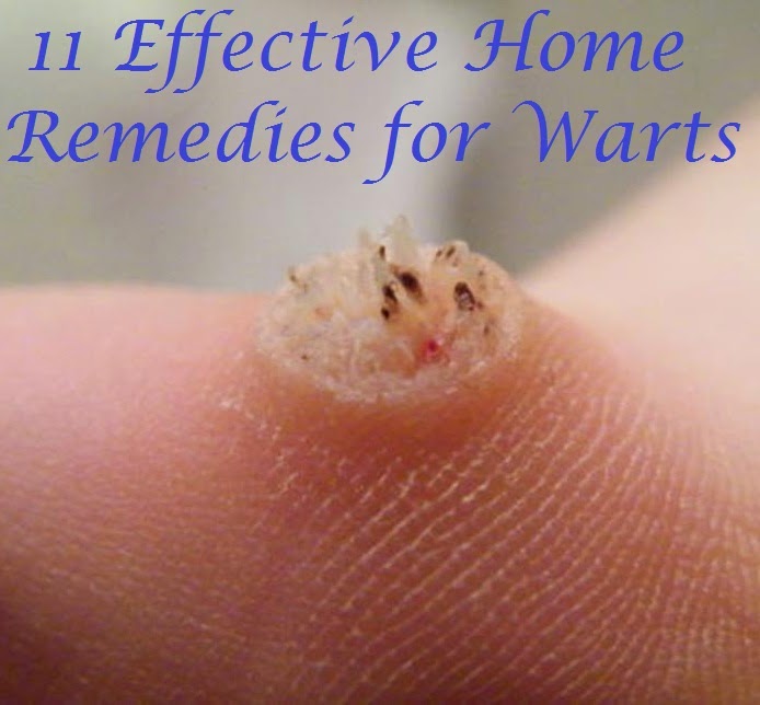 Home Remedies For Wart Removal On Knee Home Remedies For Wart Removal On Knee