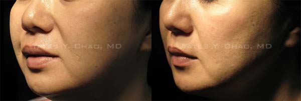 3D聚左旋乳酸雕塑整張臉 3D聚左旋乳酸雕塑整張臉, Sculptra facial recontouring by Yates Y. Chao, MD