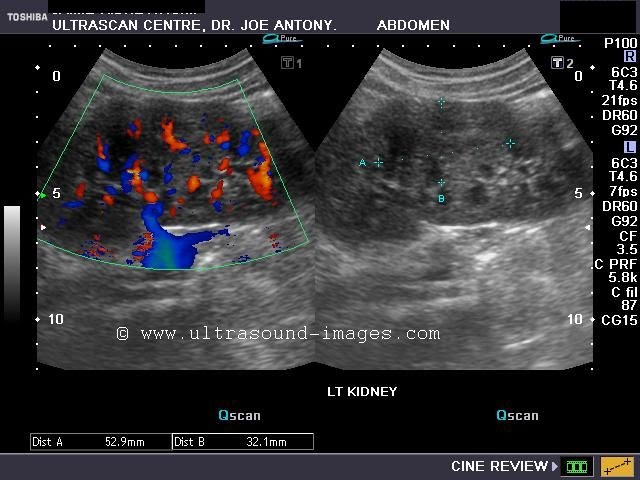red areas on a breast sonogram shaved tj asian