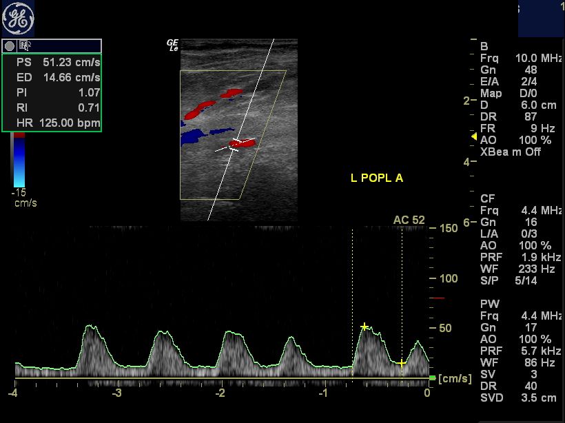 Ultrasound imaging Diabetic gangrene of the left foot arterial doppler