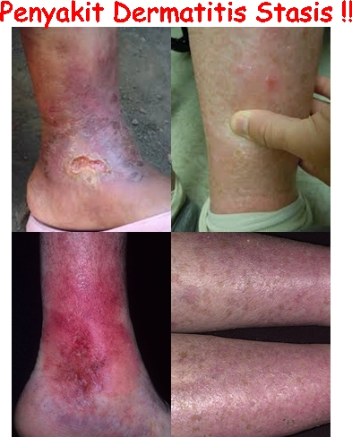 Obat Tradisional Dermatitis Stasis