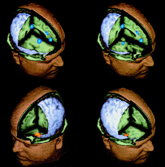 fMRI of a psychopath