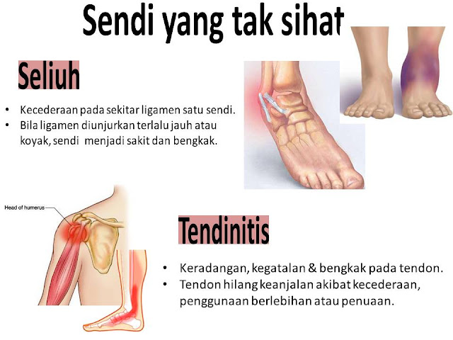 AJHT, advanced joint health tablet, sendi, Ostematrix, Omega Guard, sakit belakang, sakit lutut, sendi sihat, sendi tidak sihat,