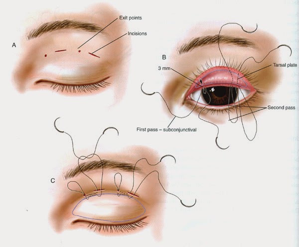 double eyelid surgery