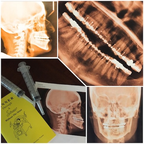 X-Rays: Prior to Underbite Surgery