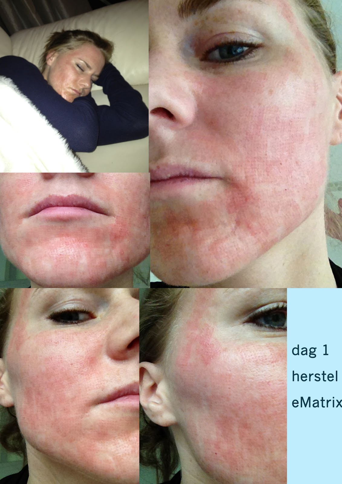gezicht laseren prijs