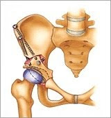 Peri-acetabular Osteotomy