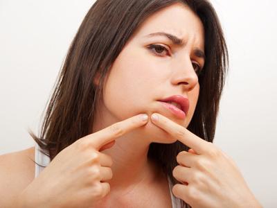 Tips dan Cara Mudah Menghilangkan Jerawat Secara Alami Tips dan Cara Mudah Menghilangkan Jerawat Secara Alami