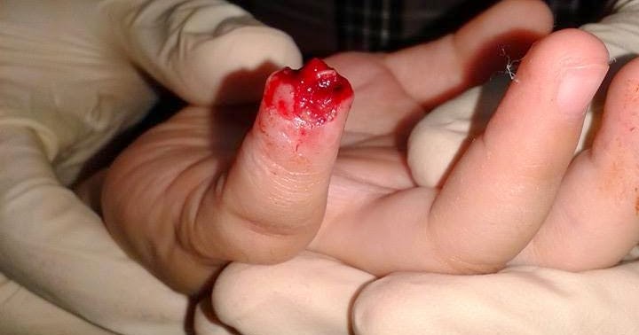 Lagi Kes Kecuaian Di Taska - Budak Putus Jari - Baby Malaysia