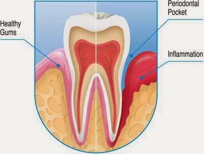 Top 11 Causes of Bleeding Gums Causes of Bleeding Gums