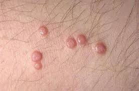 Image Cara Herbal Melenyapkan Genital Warts