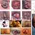 Cara Mengatasi Wasir Parah Selain Ke Klinik Bafar thumbnail