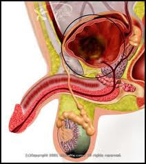 3 Nursing Diagnosis and Interventions for Bladder Cancer