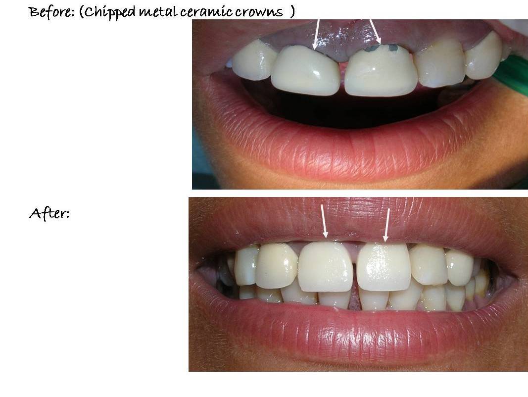 Paphos Dentist, Dr Elena Demetriou Treatment Examples