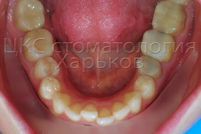 Нет боковых зубов на нижней челюсти Базальные импланты Ihde Dental Швейцария (BCS, KOS, Biomed)