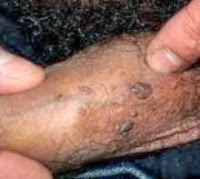 Gejala Penyakit Kutil Kelamin Gejala Penyakit Kutil Kelamin