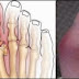 Obat Penyakit Rematik Yang Paling Alami thumbnail