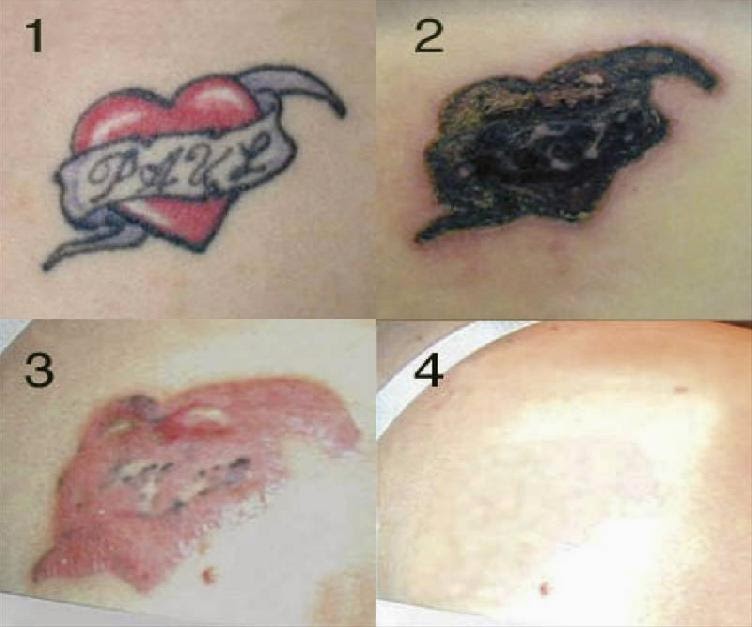 Laser Tattoo Removal Pain