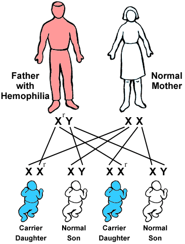 karyotype of hemophilia. on pedigrees (hemophilia).