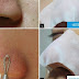 How to Use a Blackhead and Whitehead Removal Mask
