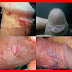 bintik-bintik merah di kelamin pria, normalkah? thumbnail