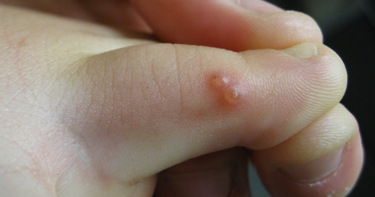 best way to treat molluscum contagiosum best way to treat molluscum contagiosum