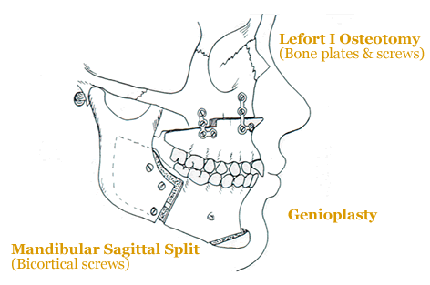 Kelly's Jaw Surgery Blog: "What's the sitch?"