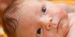 5 Steps Baby Acne Treatment
