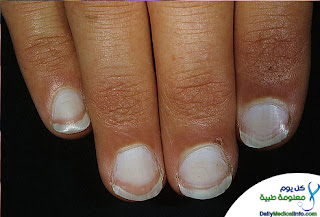 أظافرك تعبر عن حالتك الصحية Nails+(1)