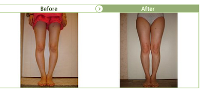causes of bowlegs, bowlegs problems, bowlegs reasons causes of bowlegs, bowlegs problems, bowlegs reasons