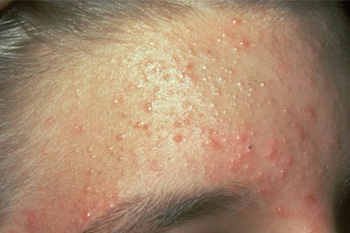 mallorca acne bilder mallorca acne bilder
