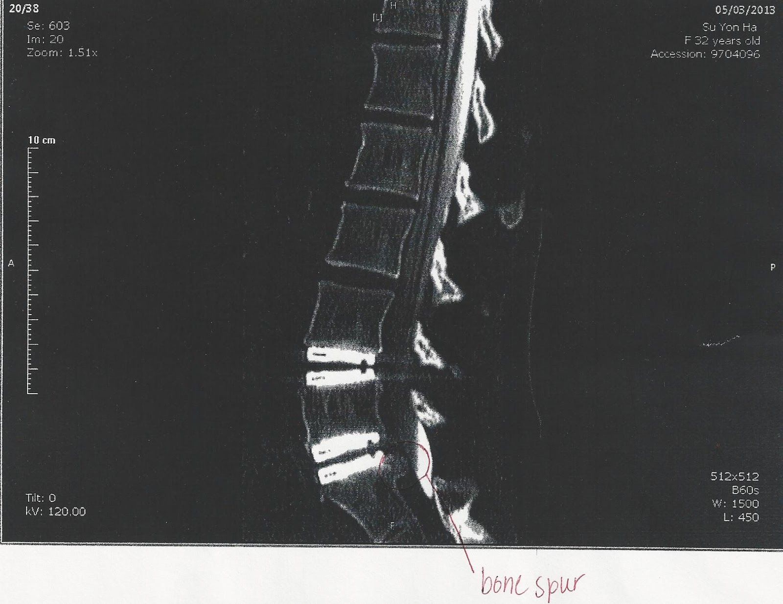 My Road to Recovery after an ADR Surgery: CT Myelogram