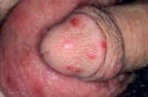 Obat Untuk Menyembuhkan Sifilis Obat Untuk Menyembuhkan Sifilis