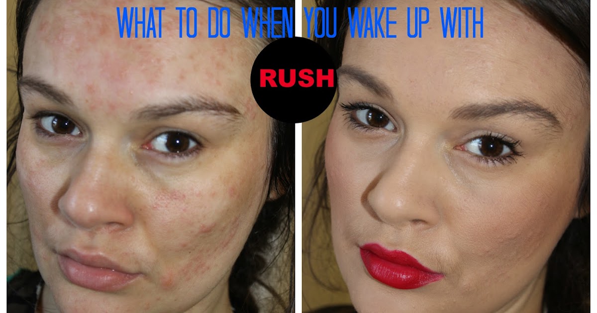 beautiful me plus you What to do if you wake up with rash on your face this is called contact
