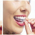 مميزات وعيوب تقويم الأسنان المخفي