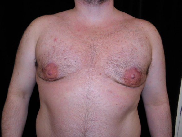 one stage gynecomastia surgery one stage gynecomastia surgery