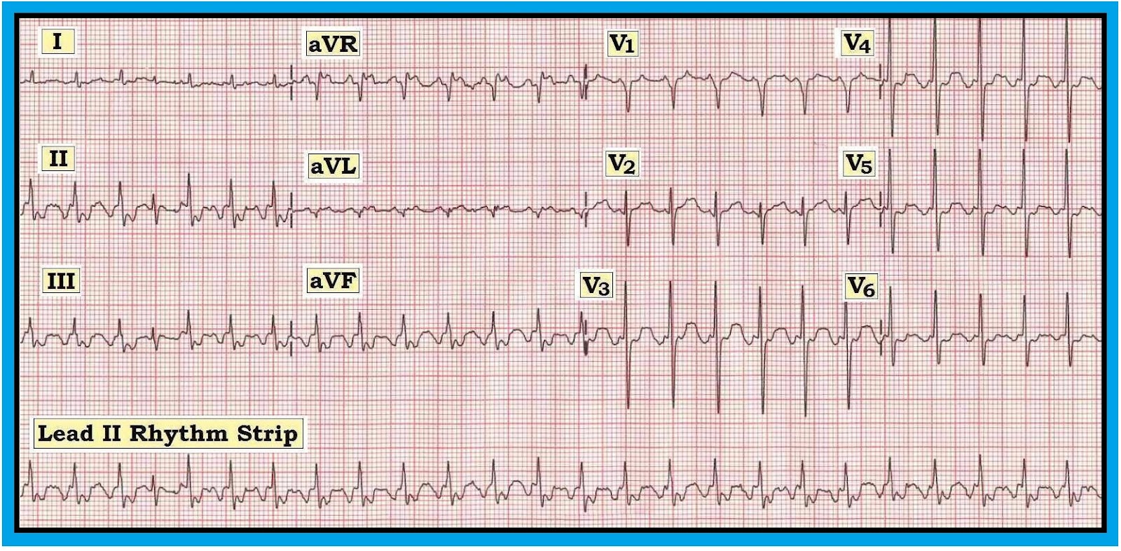 Causes Of Sinus Tachycardia Emedicine