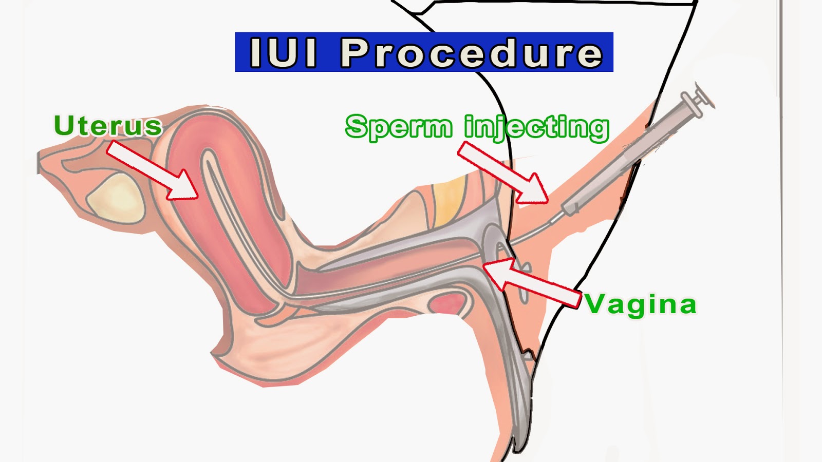 Iui when sperm count is 1 million Free pants peeing videos from snuppa