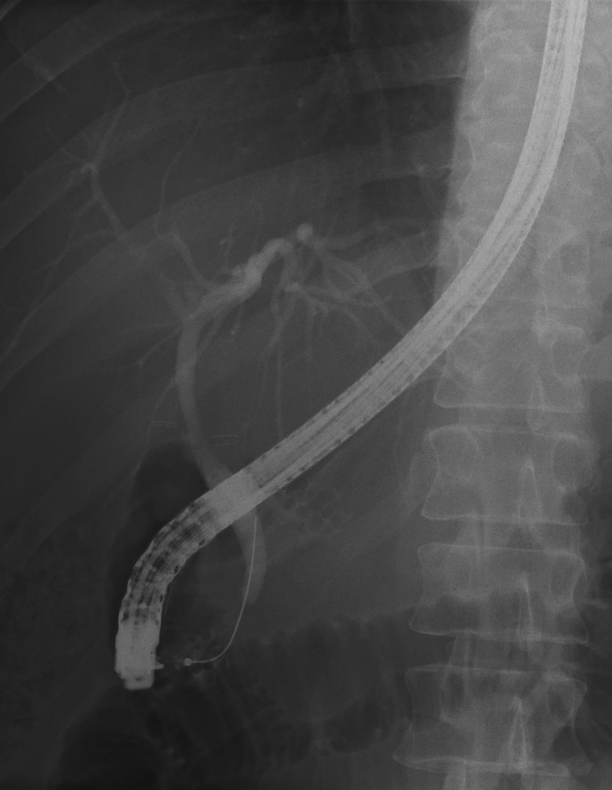 XRay Vision A Radiography Blog ERCP Anatomy, Procedure and the