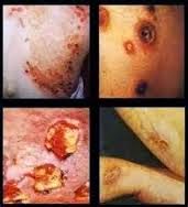 Obat Untuk Sakit Sipilis Obat Untuk Sakit Sipilis