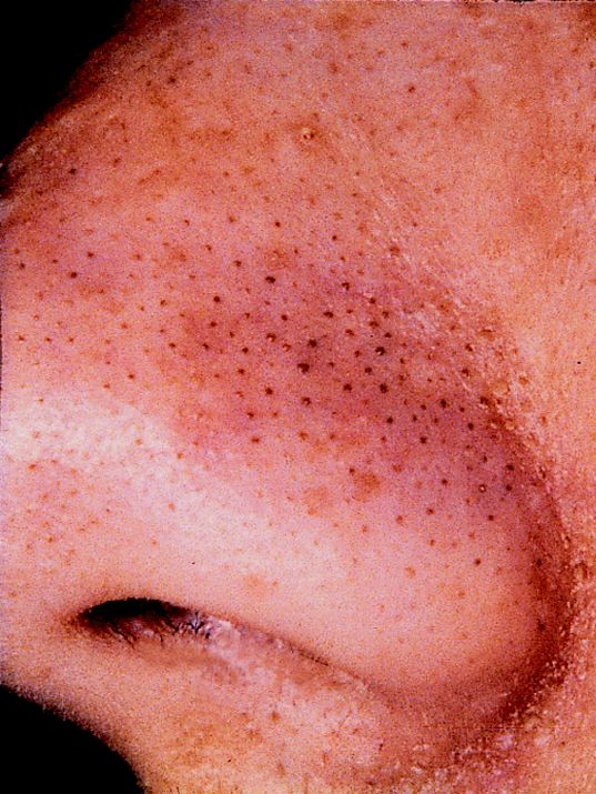 What is a blackhead acne